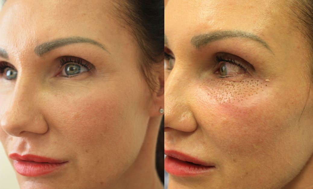 laser-treatment-for-rosacea-on-face-2-year-old