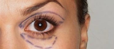 eyelid lift Manchester