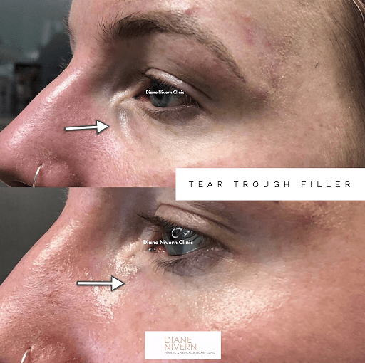 tear troughs Manchester